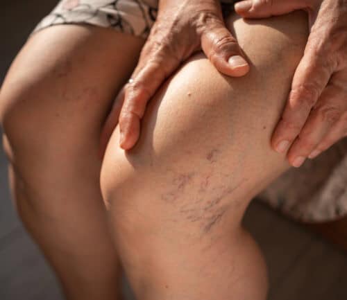 Treating broken capillaries