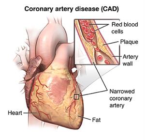 Coronary artery disease