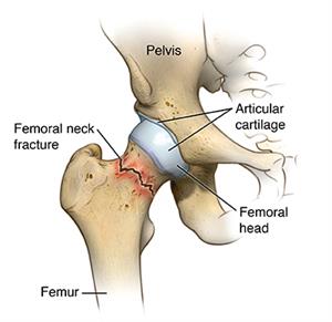 Femoral neck fracture