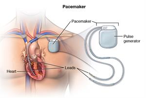 OCardio_20140304_v0_001 Pacemaker