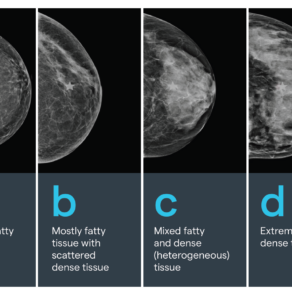 Diagram of four types of breast density