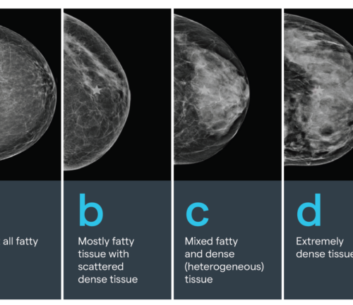 Diagram of four types of breast density
