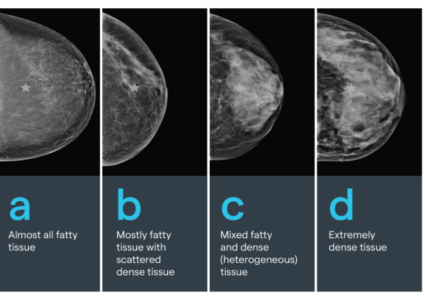 Diagram of four types of breast density