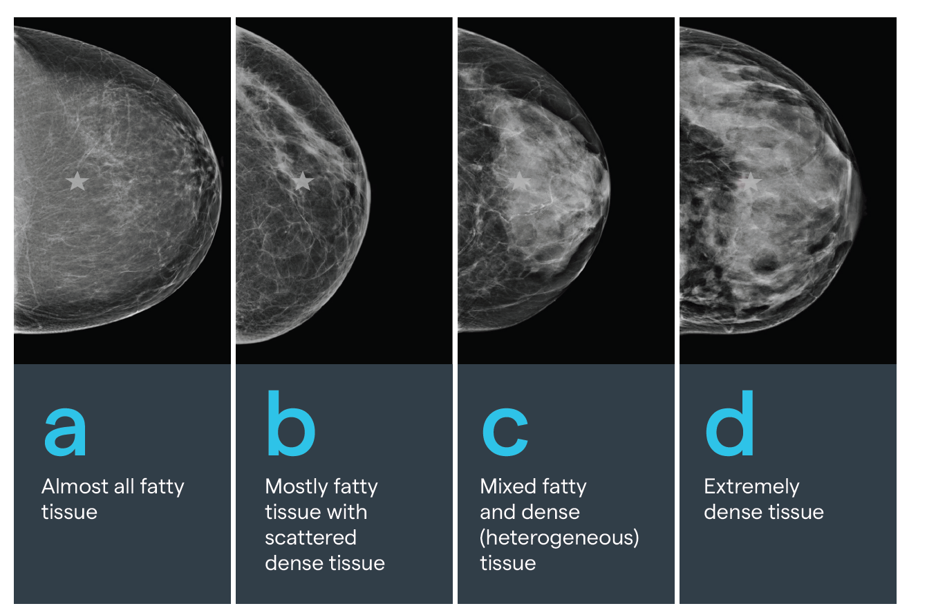 Diagram of four types of breast density