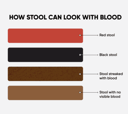 Four different colors of blood in stool